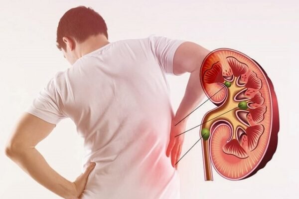 Kidney stone problem Result